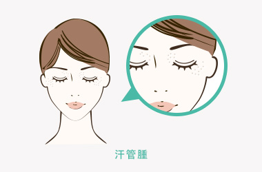 汗管腫について