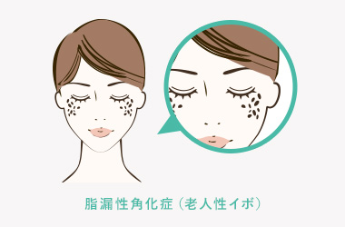 脂漏性角化症（老人性イボ）について