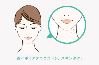 首イボ（アクロコロドン、スキンタグ）について
