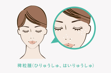 稗粒腫(ひりゅうしゅ、はいりゅうしゅ)について