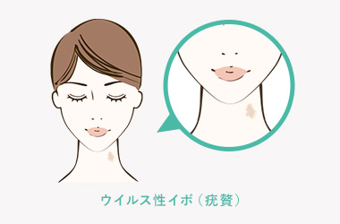 ウイルス性イボ（疣贅）について