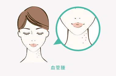 血管腫について