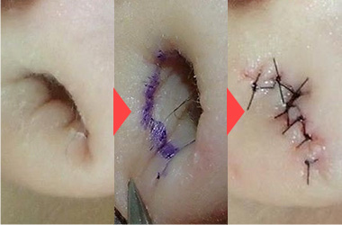 ピアス穴径1-2cmまたはそれ以上の大きいピアス穴