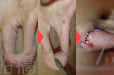 超巨大ピアス穴の閉鎖術