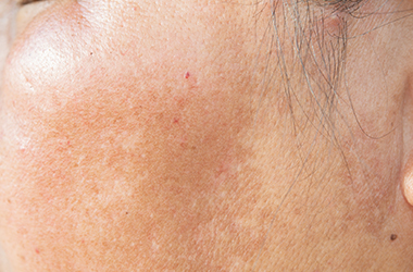 くすみ・薄ジミ・肝斑を徐々に改善 ピコトーニング