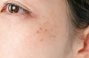 ピコトーニング